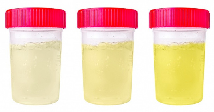 7 неща, които различният цвят на урината сигнализира за вашето здраве
