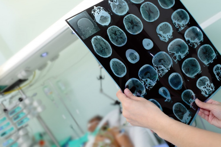 Магнитна стимулация образува паметови клетки при Алцхаймер 