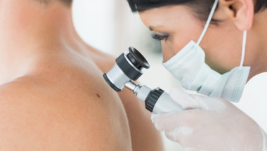 Д-р Даниел Янков: Хормоналните проблеми може да провокират рак на кожата!