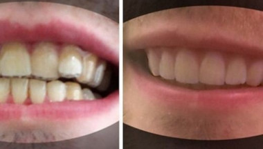 Студент сам си оправи кривите зъби и спести хиляди долари от брекети (СНИМКИ)