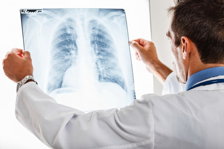 Саркоидозата засяга най-вече белите дробове 