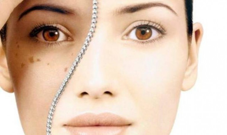 5 натурални съставки премахват тъмните петна по кожата