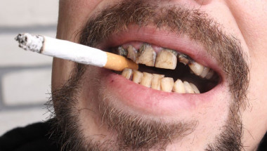 Д-р Георги Хараланов: Болните зъби могат да доведат до рак на устата