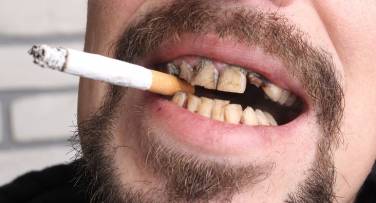 Д-р Георги Хараланов: Болните зъби могат да доведат до рак на устата