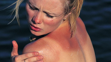 Д-р Малена Герговска: Мазила причиняват алергичен дерматит при излагане на слънце