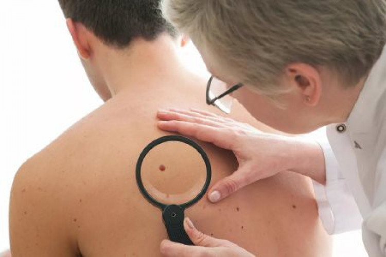 Научен пробив! Учени от  университета Корнел откриха какво предизвиква рака на кожата
