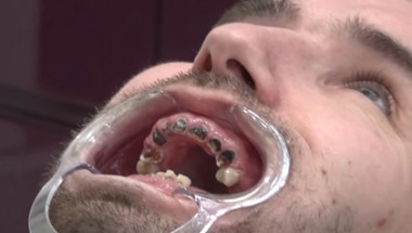 Ирландец остана без зъби заради пристрастеността му към газираните напитки