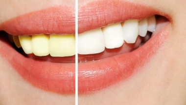 Зъболекарите са удивени! Тази рецепта избелва зъбите по-добре от тях