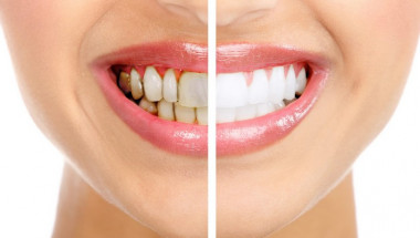 12 продукта правят истински чудеса със зъбите ви