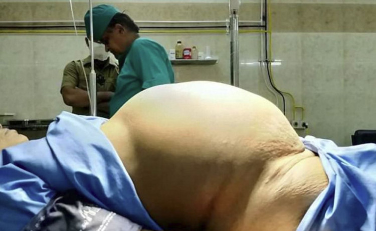 Медицинско чудо! Отстраниха близо 12-килограмов тумор от яйчника на "бременна" пенсионерка (СНИМКИ 18+)