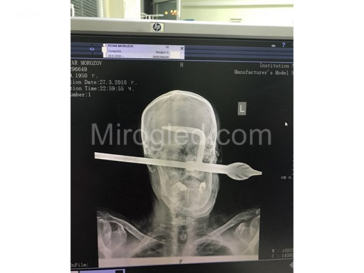 Перничанин с 10-сантиметров метален шип, стърчащ от черепа, шашна лекарите (СНИМКИ 18+)