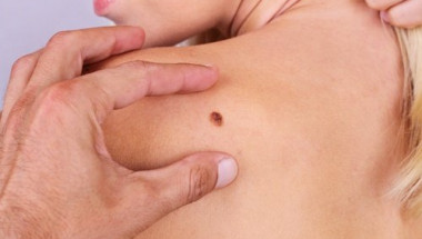 4 неща, които дори не подозирате за рака на кожата