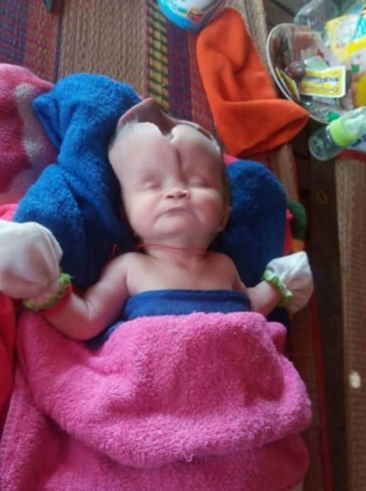 Лекарите са изумени как това бебе с половин череп все още е живо (СНИМКИ)