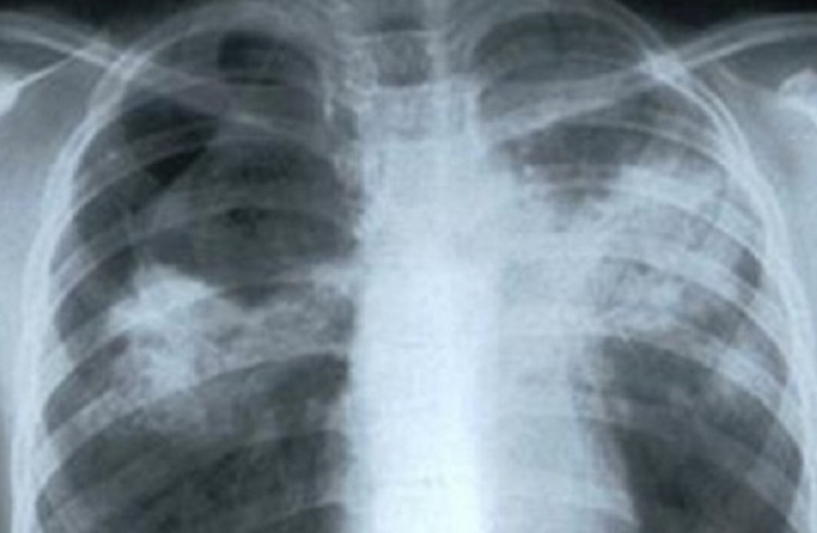 Водещ бг онколог посочи симптомите на рак на белия дроб