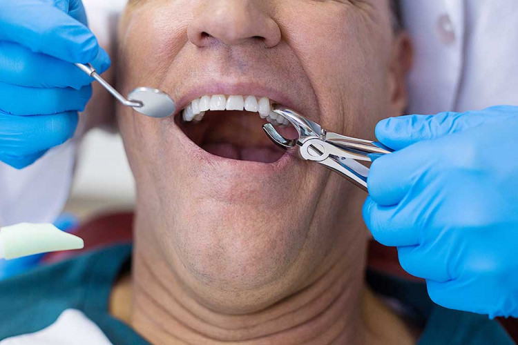 Опадането на зъби  след 45-годишна възраст предсказва инфаркт