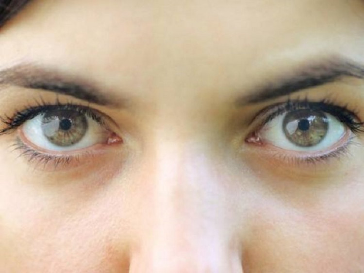 Бърз тест: Имате ли проблем с холестерола, само погледнете очите си