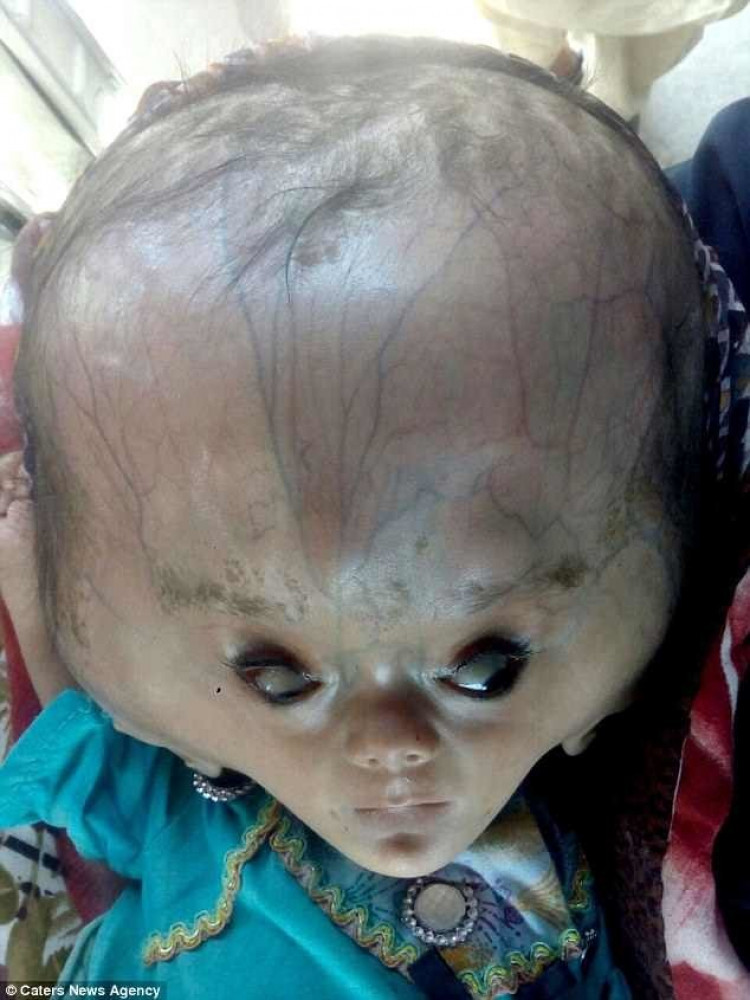 Сензационна развръзка с драмата на бебето с глава на извънземно (СНИМКИ)