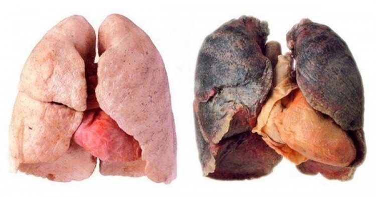 Как да почистите белите дробове след пушене: 4 начина, по които ще премахнете токсините от тялото!