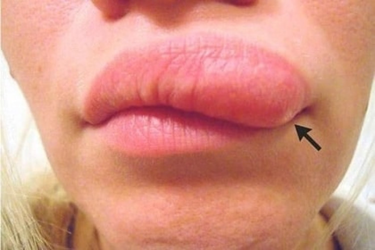 Подутина в устните на жена се оказа нещо ужасяващо (СНИМКИ)