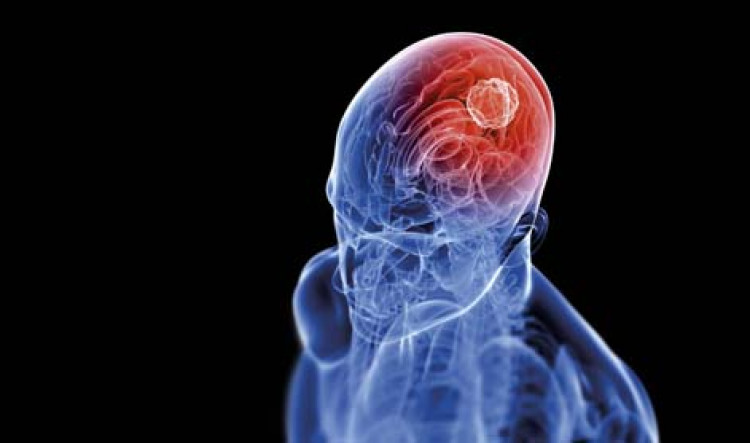 Симптомите, които алармират за тумор в мозъка
