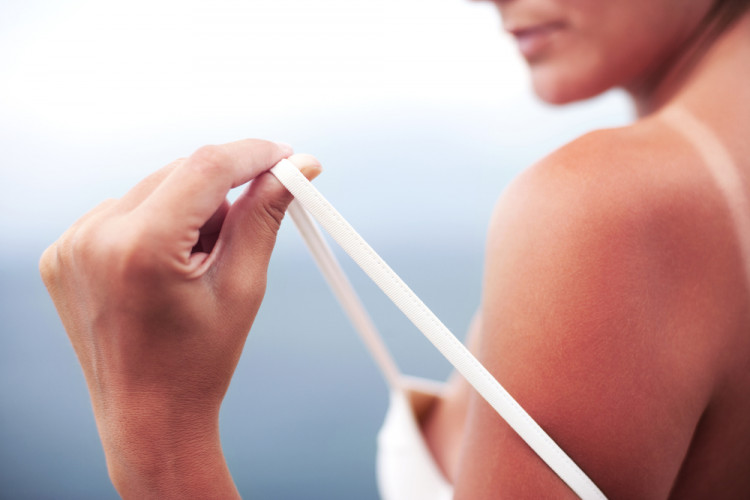 US-дерматолог посочи най-доброто средство за слънчево изгаряне - намира се в хладилника ви