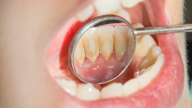 Д-р Гергана Мичева: Плаката  по зъбите се държи като отделен организъм