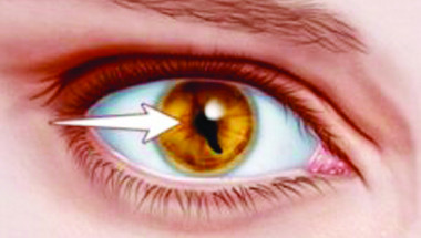 Доц. д-р Красимир Коев, д.м.: Синдромът  на котешките очи е рядко хромозомно разстройство