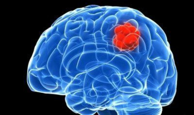 Това са най-ясните симптоми за тумор в мозъка