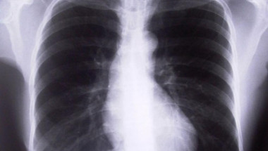 Посочиха основен симптом за появата на рак на белите дробове