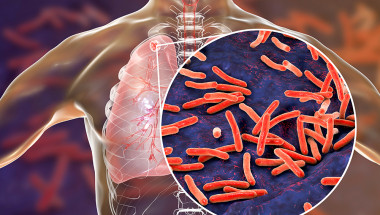 Д-р Веселин Давчев: Туберкулозата може да се развие във всеки орган