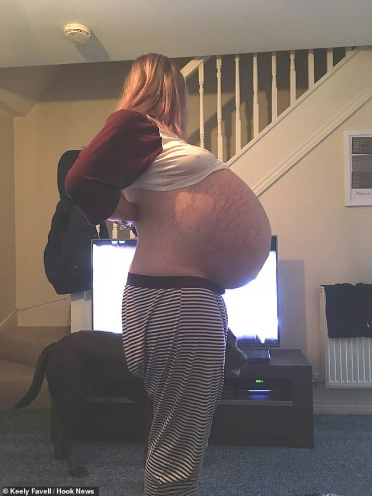Кийли имаше огромен корем, мислеше, че е бременна, но три теста се оказаха отрицателни, а истината зловеща (ШОКИРАЩИ СНИМКИ)