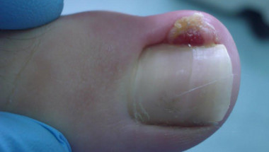 Внимание, това заболяване може да доведе до ампутация на пръстите!