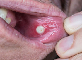 Мнозина пренебрегват този симптом на рак на устата