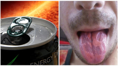 Шокиращи СНИМКИ! Учител пиеше по 6 енергийни напитки дневно без да подозира какво ще се случи с езика му