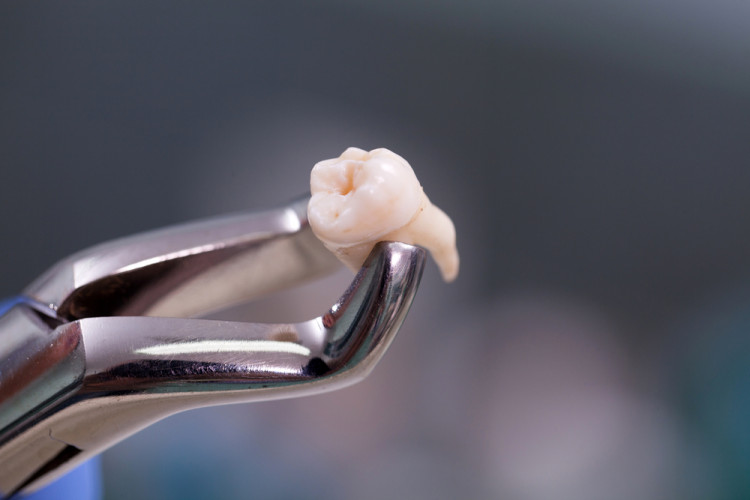 Д-р Богомил Стоев: Сухият алвеолит често възниква след вадене на зъб