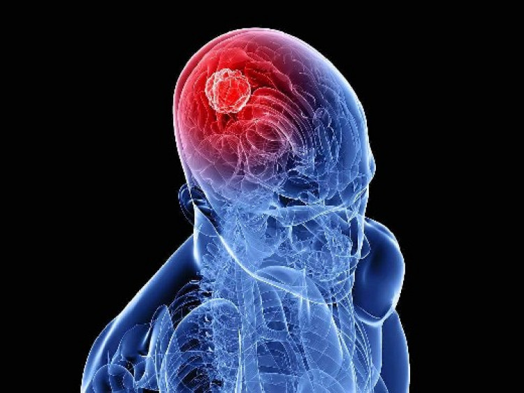 Онколози назоваха първите 7 симптома на рак на мозъка