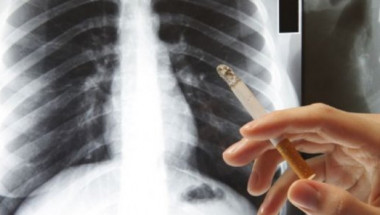 Непушачите не са застраховани! Кои са ранните симптоми на рак на белия дроб