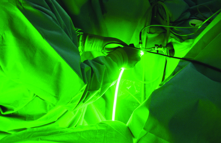 Лазерната операция - най-съвременният метод за лечение на увеличена простата