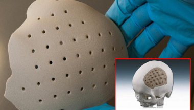 Д-р Асен Хаджиянев: 3D имплант заменя липсващи кости на черепа