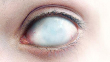 Жена ослепя с едното си око заради лещи