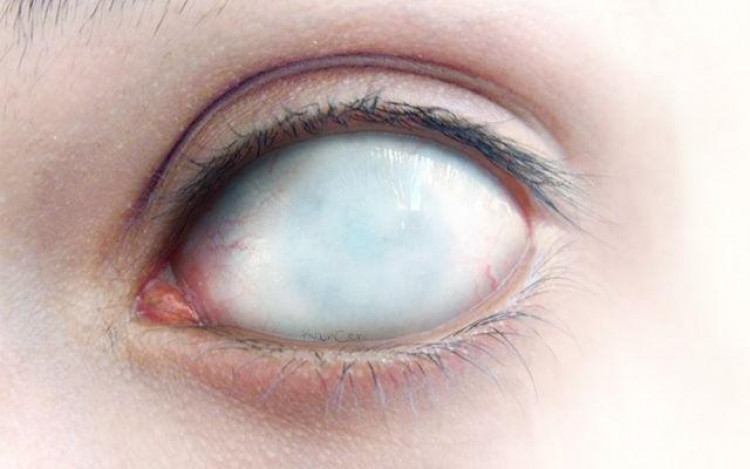 Жена ослепя с едното си око заради лещи