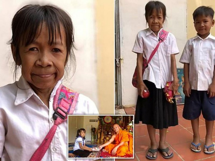 Странна болест превърна 10-годишно момиче в стара жена