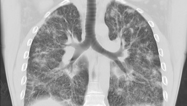 6 правила за здрави бели дробове: не давайте шанс на рака
