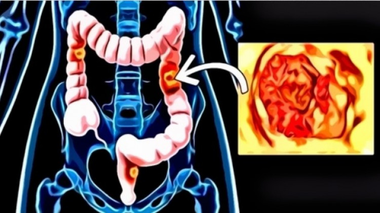Колко време живеят хората с диагноза рак на дебелото черво?
