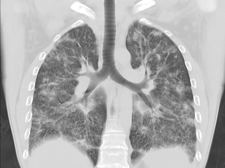 6 правила за здрави бели дробове: не давайте шанс на рака