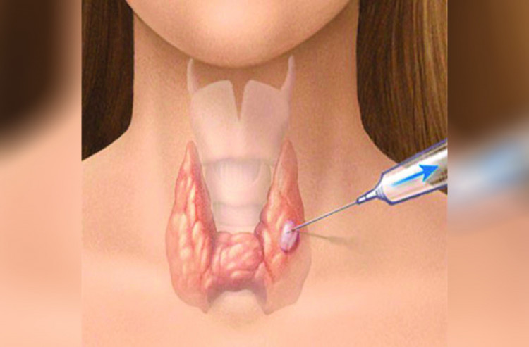 Доц. д-р Боян Нончев: Повечето възли на щитовидната жлеза не причиняват симптоми