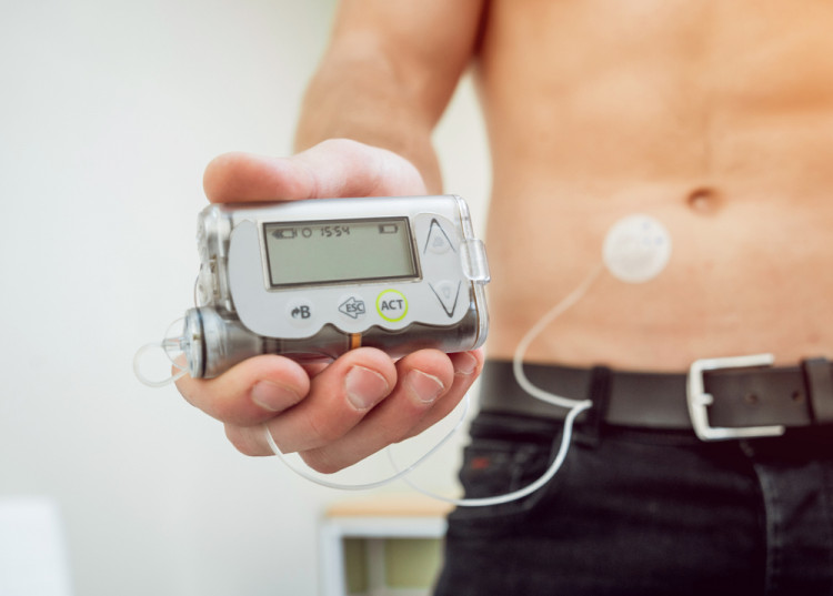 Полага ли се инсулинова помпа  по НЗОК на възрастни пациенти?