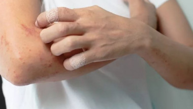 Дерматолог обясни защо безпричинният сърбеж на кожата е опасен