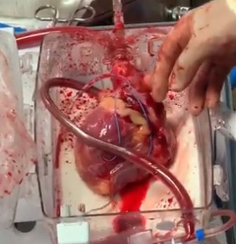 Хирурзи извадиха сърцето на мъртвец и показаха как бие ВИДЕО 18+