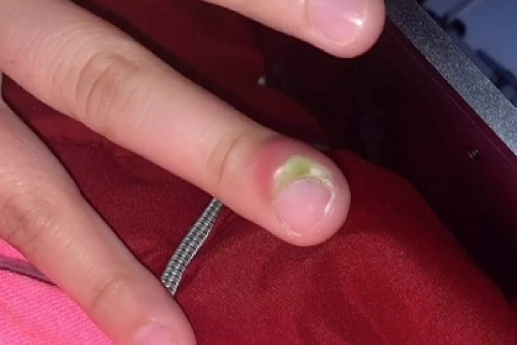 Плашещата история на студентка за опасността от гризането на нокти СНИМКА